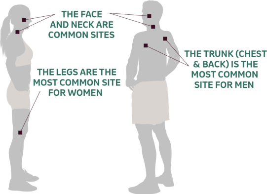 Melanoma common areas in men and women graphic