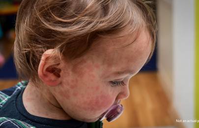 little girl with measles