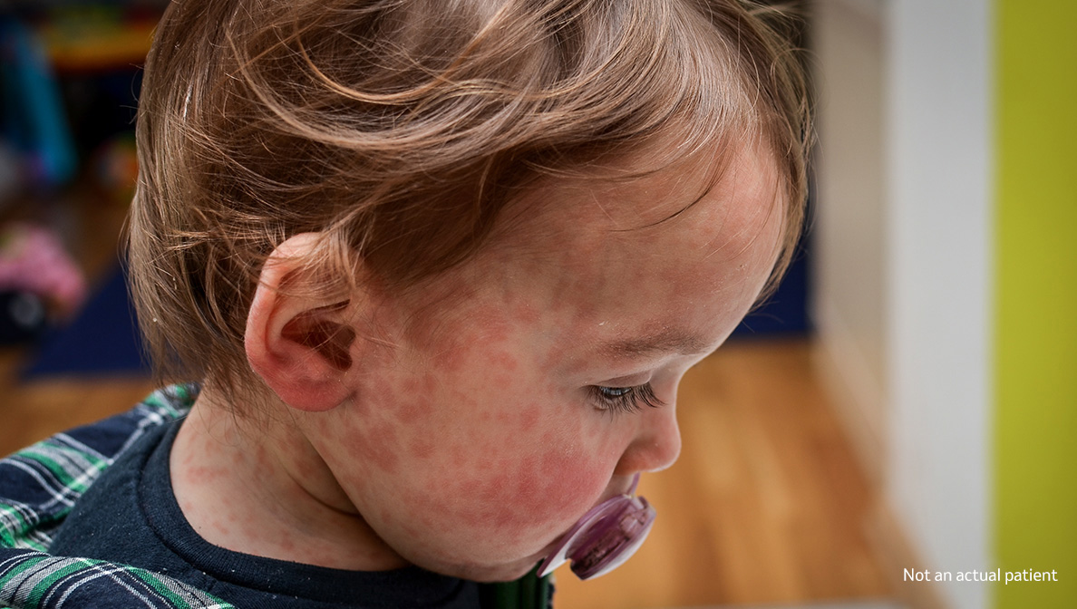 little girl with measles