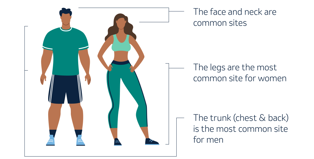 Melanoma common sites