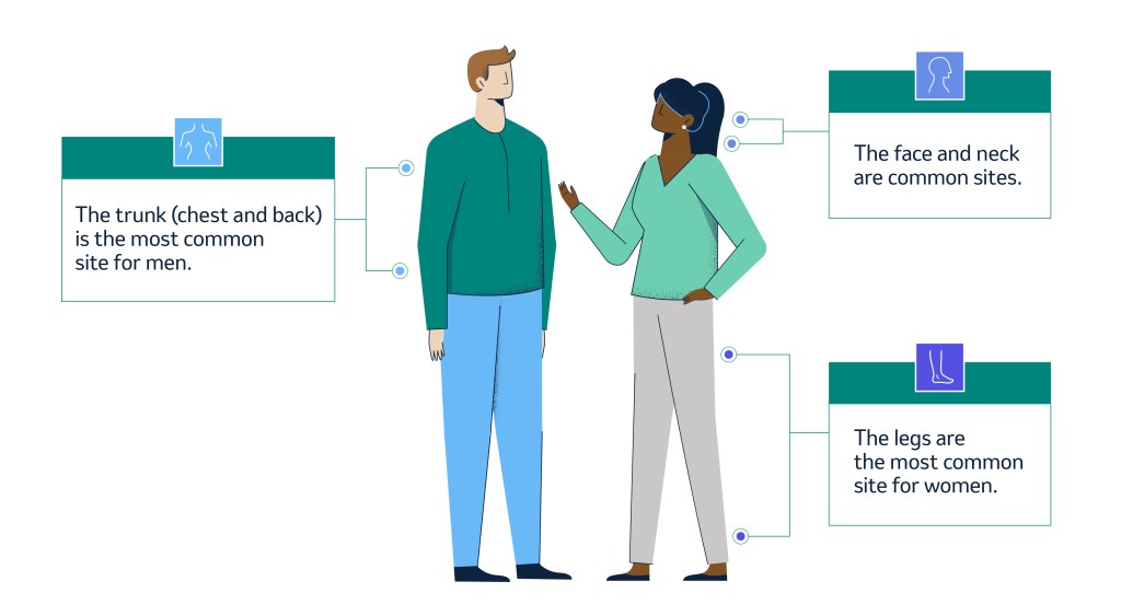 Illustration of man and woman. Notes indicate common locations of melanoma.