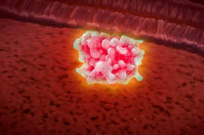 Image for Exploring KRAS: A precision approach in oncology