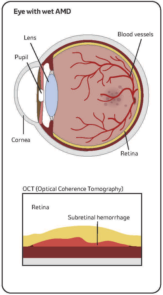 illustration of an eye with retinal disease AMD