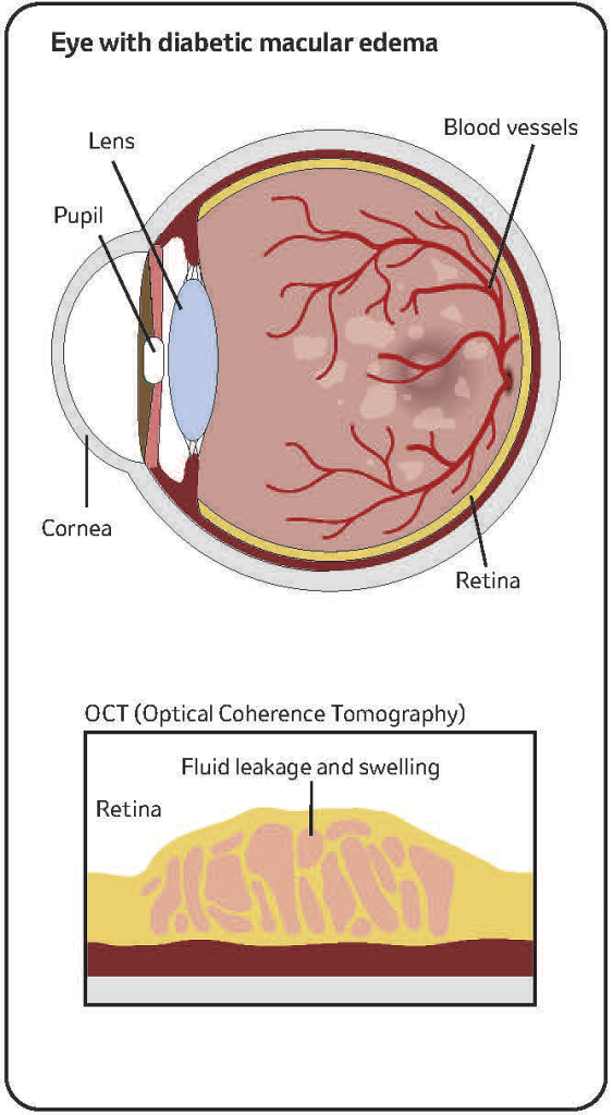 illustration of an eye with retinal disease DME